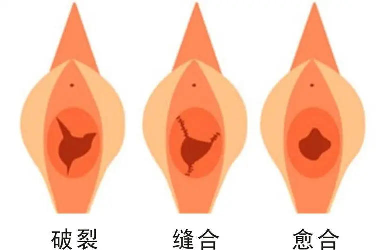 處女膜修復(fù)前后要注意事項(xiàng)有哪些